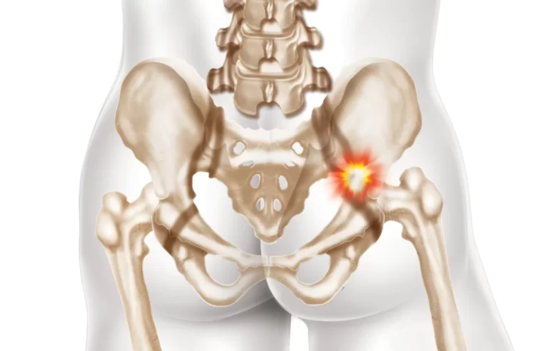 Casos de fratura de quadril devem crescer 4 vezes mais no Brasil por falta de tratamento para a osteoporose