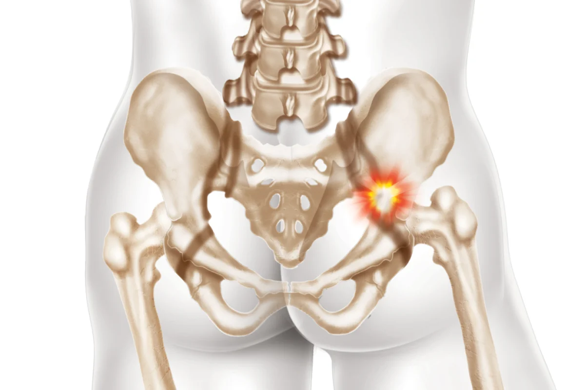 Casos de fratura de quadril devem crescer 4 vezes mais no Brasil por falta de tratamento para a osteoporose