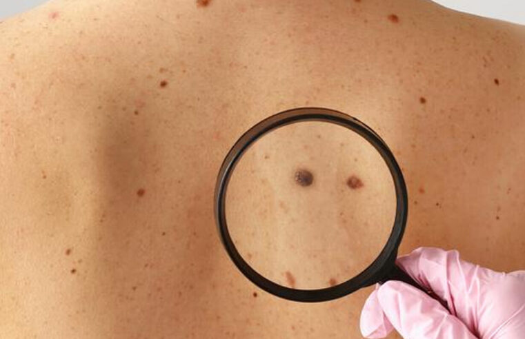 Mortes por melanoma no Brasil podem aumentar 80% até 2040 