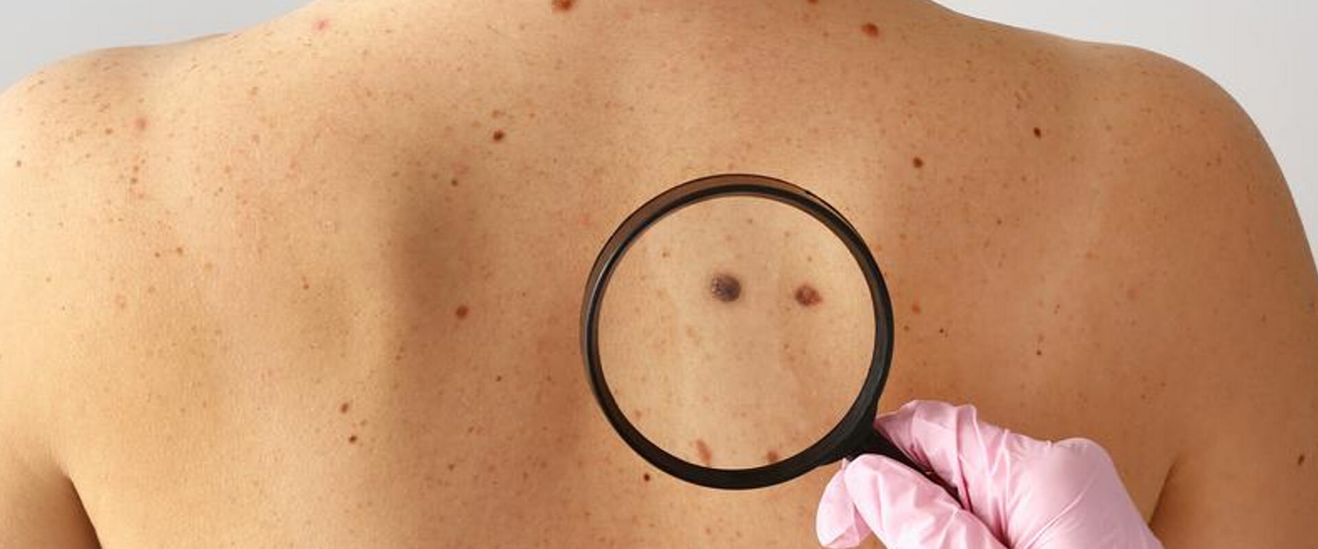 Mortes por melanoma no Brasil podem aumentar 80% até 2040 