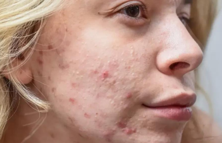 Acne pode surgir em qualquer pessoa e em qualquer idade