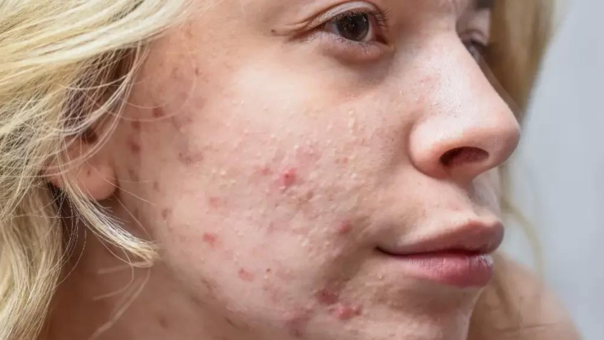 Acne pode surgir em qualquer pessoa e em qualquer idade