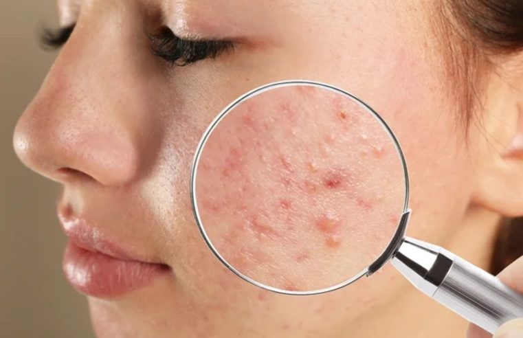 Acne: cientistas projetam bactérias inteligentes para tratar doença 