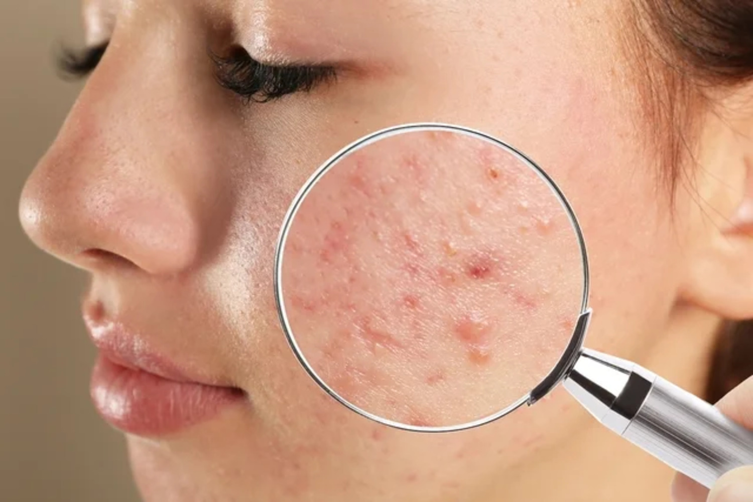 Acne: cientistas projetam bactérias inteligentes para tratar doença 