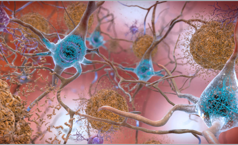 Droga que retarda progressão do Alzheimer em estágios iniciais é eficaz, aponta estudo