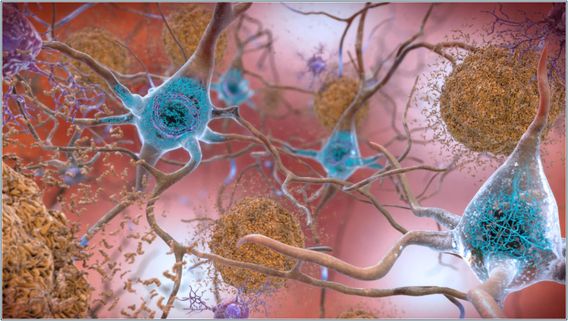 Droga que retarda progressão do Alzheimer em estágios iniciais é eficaz, aponta estudo