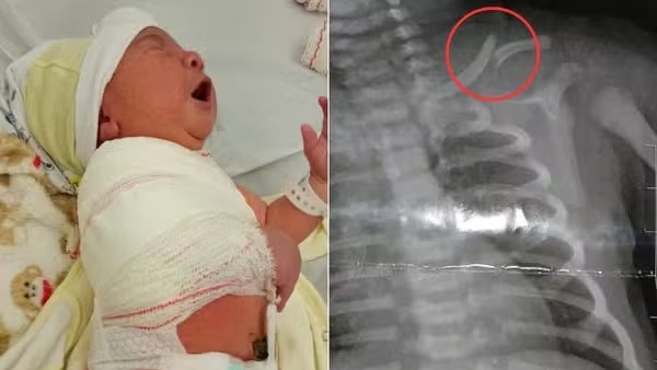 Mãe de bebê que teve clavícula fraturada no parto denuncia hospital por negligência e é notificada ao Conselho Tutelar