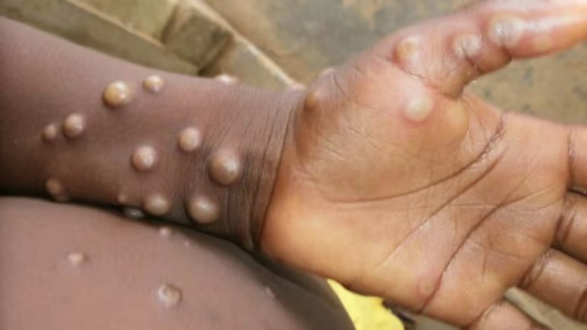 China confirma casos da nova variante de mpox, mas garante controle da epidemia