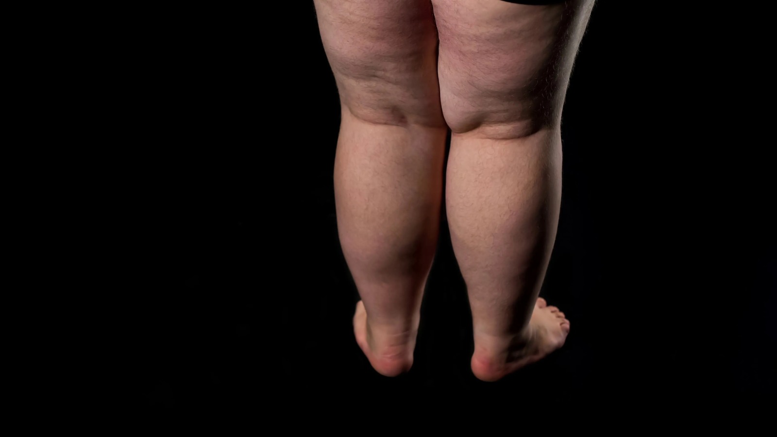 Lipedema: cortar bebida alcoólica é essencial no tratamento