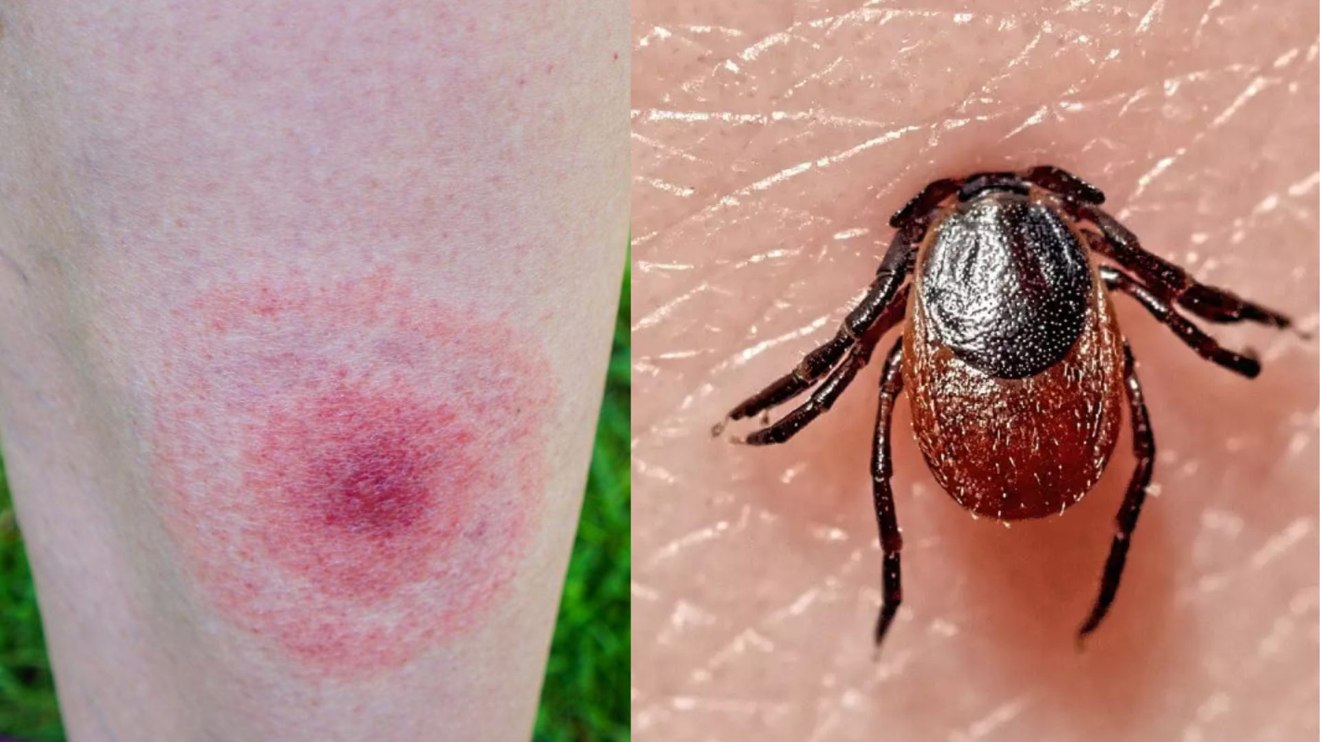 Doença de Lyme: negligência médica e atraso no diagnóstico motivam campanha por visibilidade no Brasil